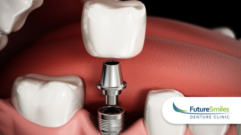 The Pros And Cons Of Denture Implants